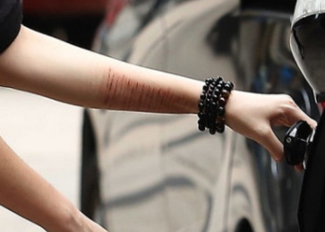 成龙女儿,小龙女卓林出院,手臂上几十条自残伤痕触目惊心